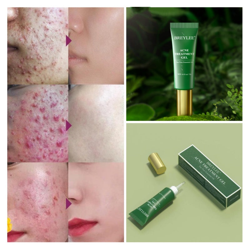 Tea Tree Acne Gel 15g Emergency Type Amazon Cross-border