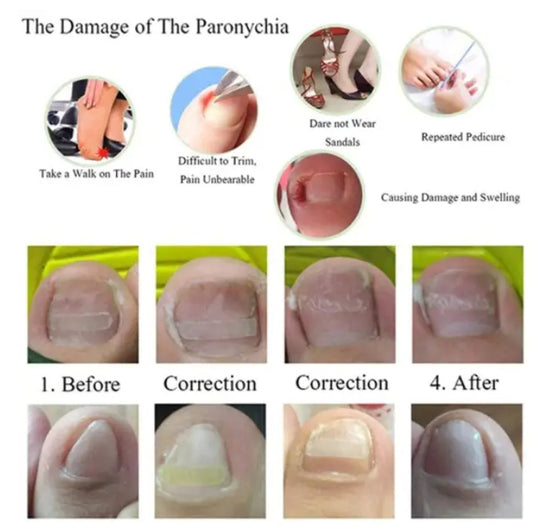 Dedicated Ingrown Nail Orthodontic Correction Patch Inflammation Manicure Clippers