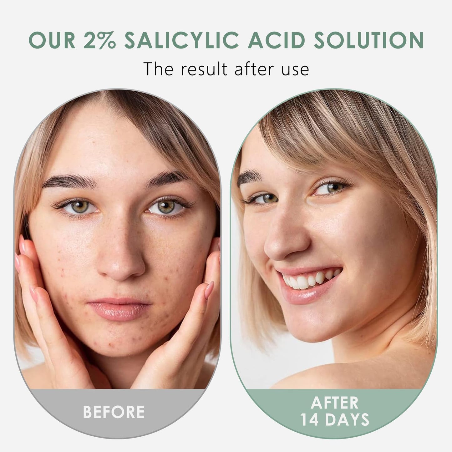 Salicylic Acid Serum 30 ml, salicylsyraserum minska porerna, ansikte exfoliant med salicylsyra, mot finnar