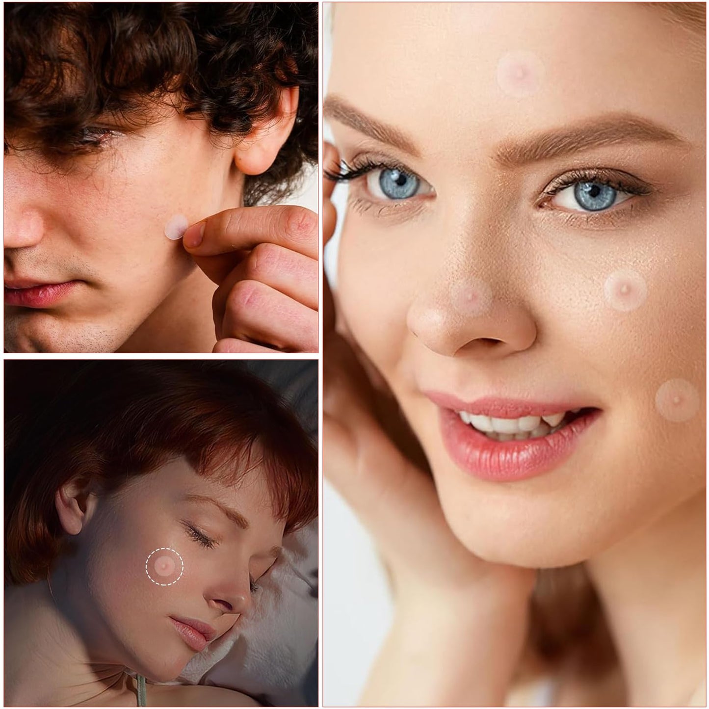 SHUOHONG 144 stycken Acne Patch Hydrokolloid Acne Patches Korn, Pimple Teolja Patches, osynliga fläckar, ansiktsbehandling, lämplig för alla hudtyper