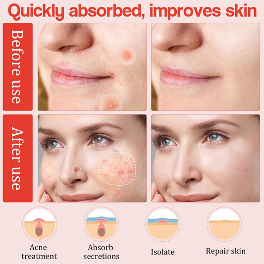 SHUOHONG 144 stycken Acne Patch Hydrokolloid Acne Patches Korn, Pimple Teolja Patches, osynliga fläckar, ansiktsbehandling, lämplig för alla hudtyper