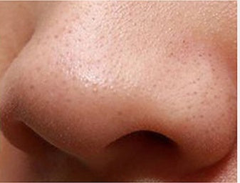 Cold And Hot Compress Blackhead Cleaning Beauty Instrument